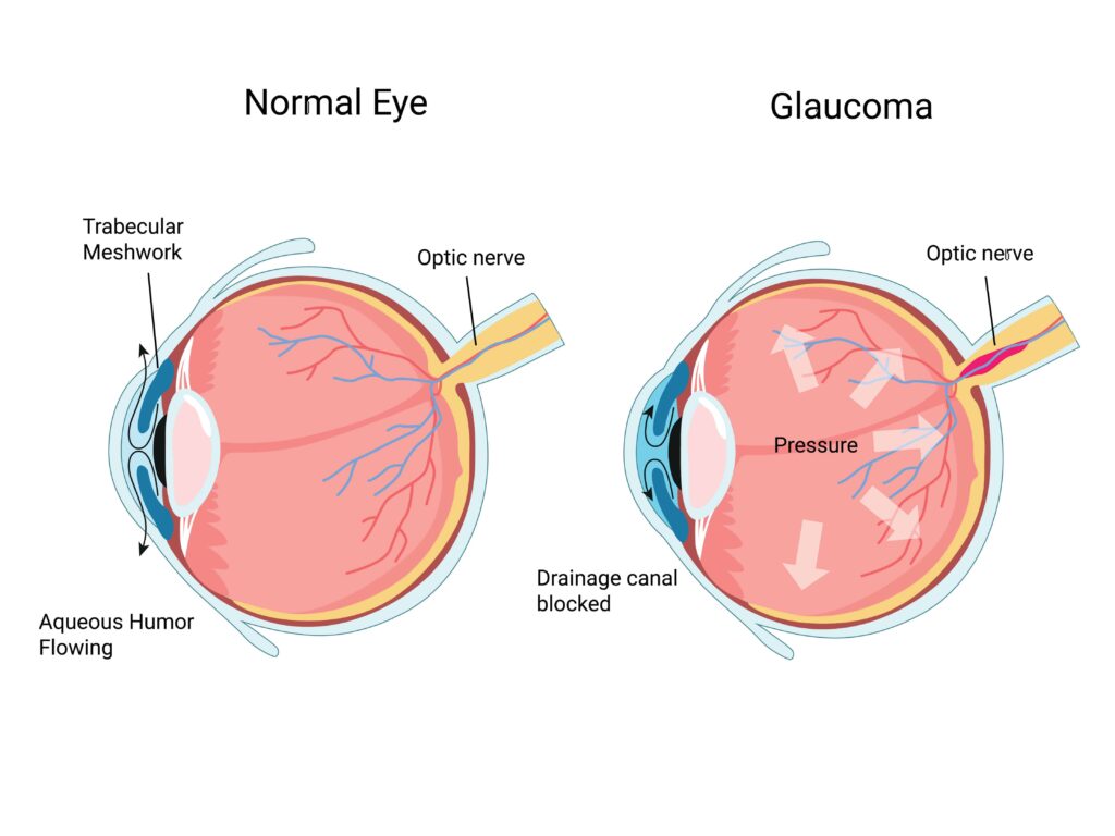 What Is Glaucoma? Diagram explaining what Glaucoma is