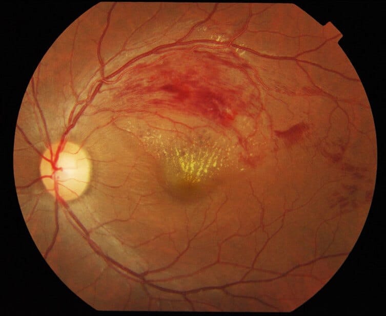 Branch retinal vein occlusion