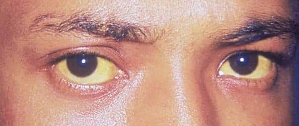 Jaundice-Eyes Jaundice Eyes