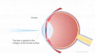 Lasek-Vs-Lasik-Eye-Surgery-For-Sports LASEK eye surgery from Focus Clinics