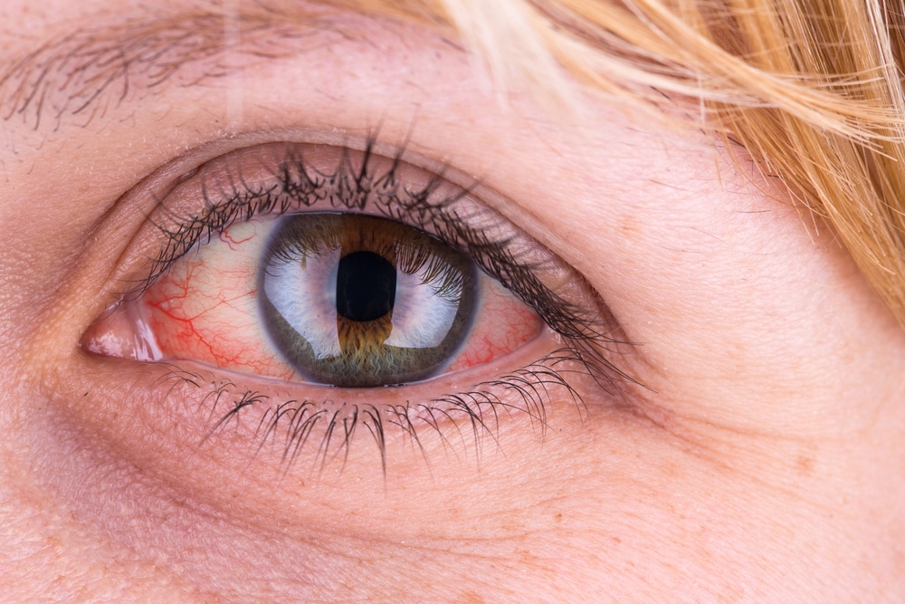 Watery-red-eyes Watery red eyes