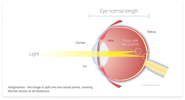 Astigmatism eye diagram