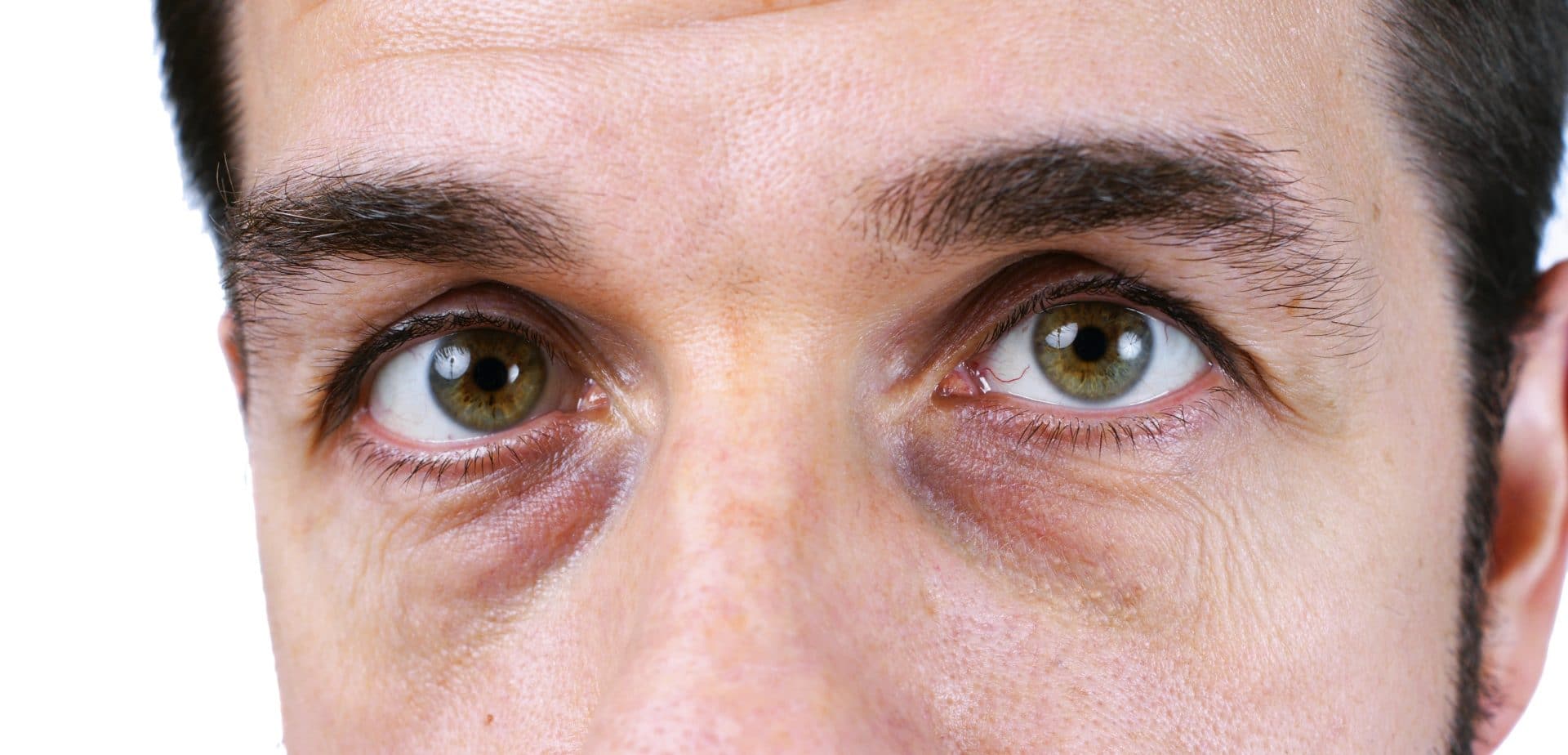 Close up of man with dark circles under his eyes