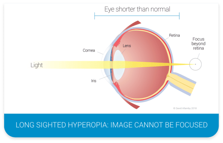 Long sighted hyperopia eye diagram