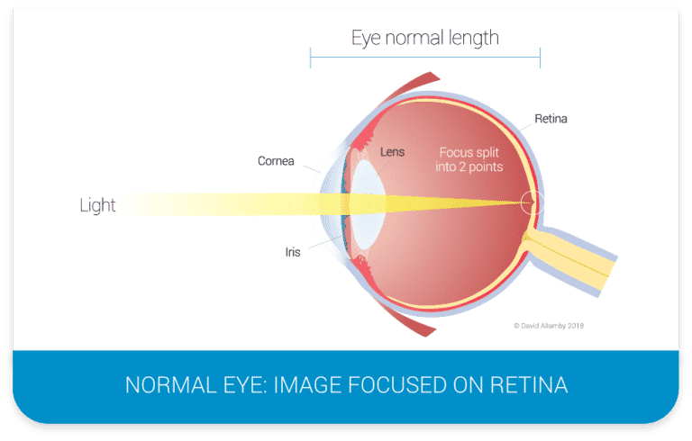 Normal eye diagram