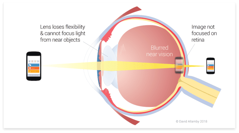 Presbyopia eye diagram