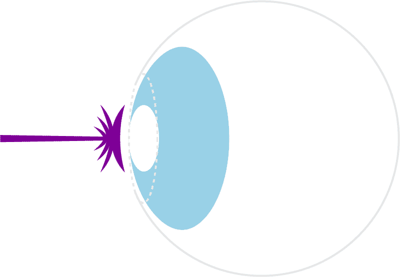 LASIK laser eye procedure