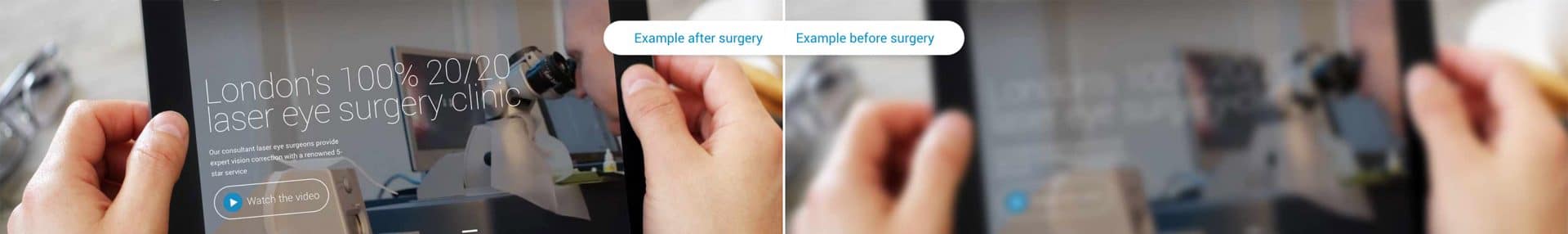 Refractive lens exchange before and after