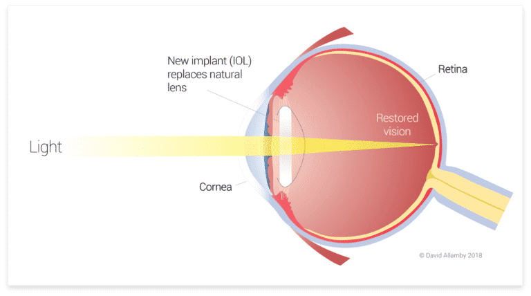 Lens Replacement Surgery (Refractive Lens Exchange) | Focus Clinics