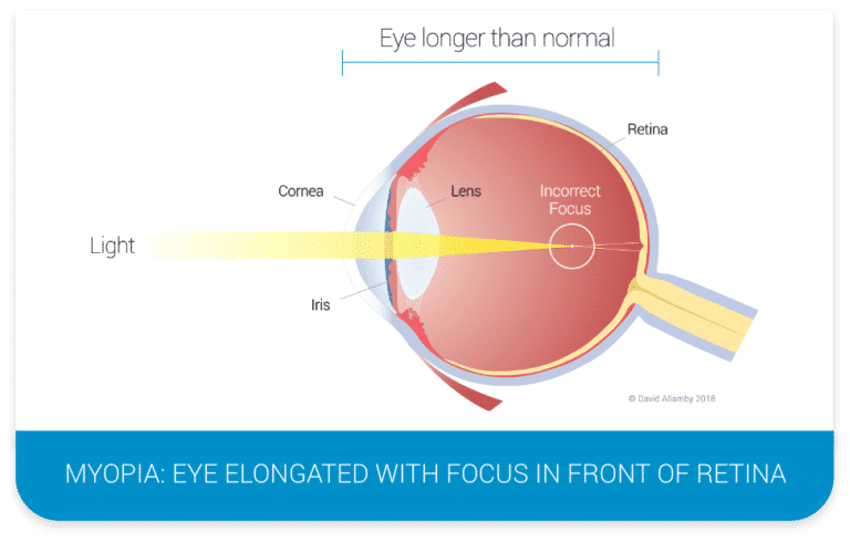 Short Sighted Myopia Diagram