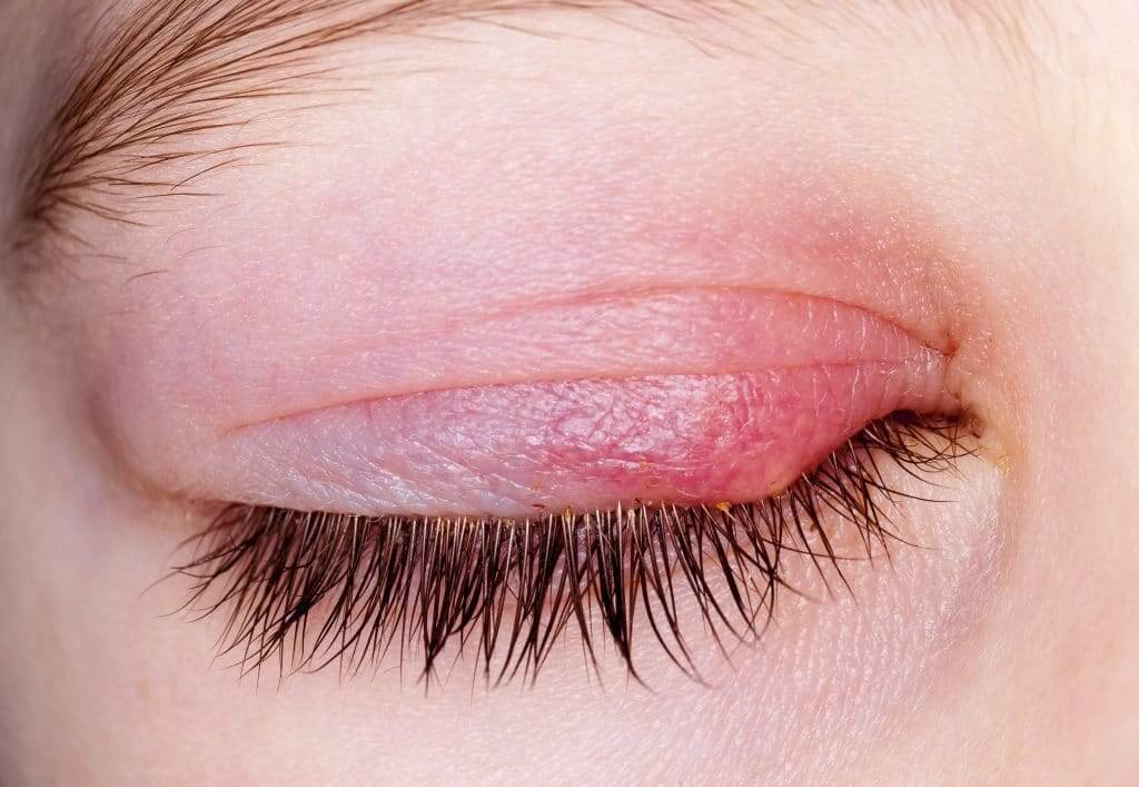 The 5 Most Common Eye Infections (And How To Avoid Them) Focus Clinics