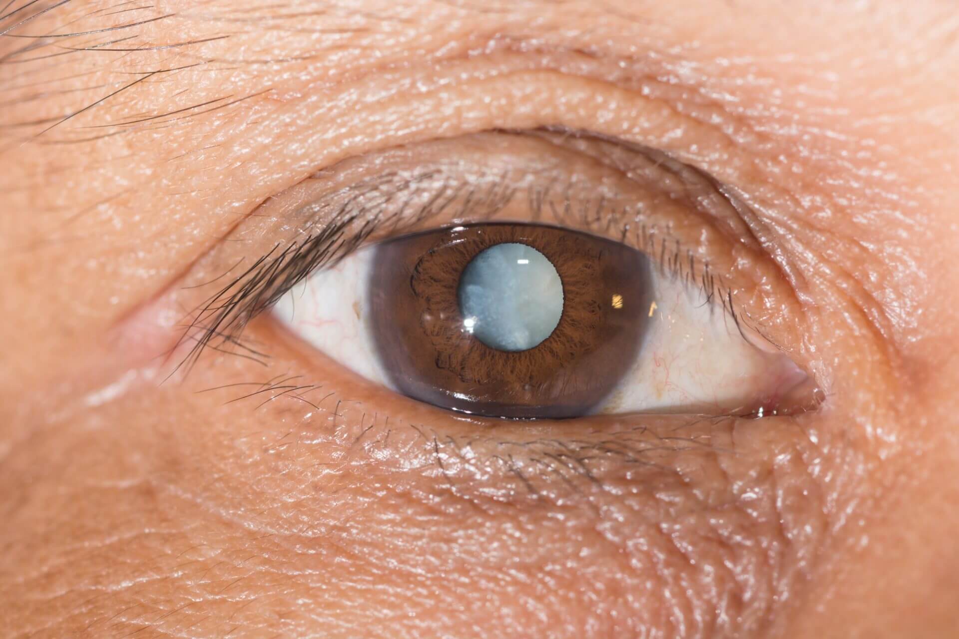 Close up of an eye with a cataract