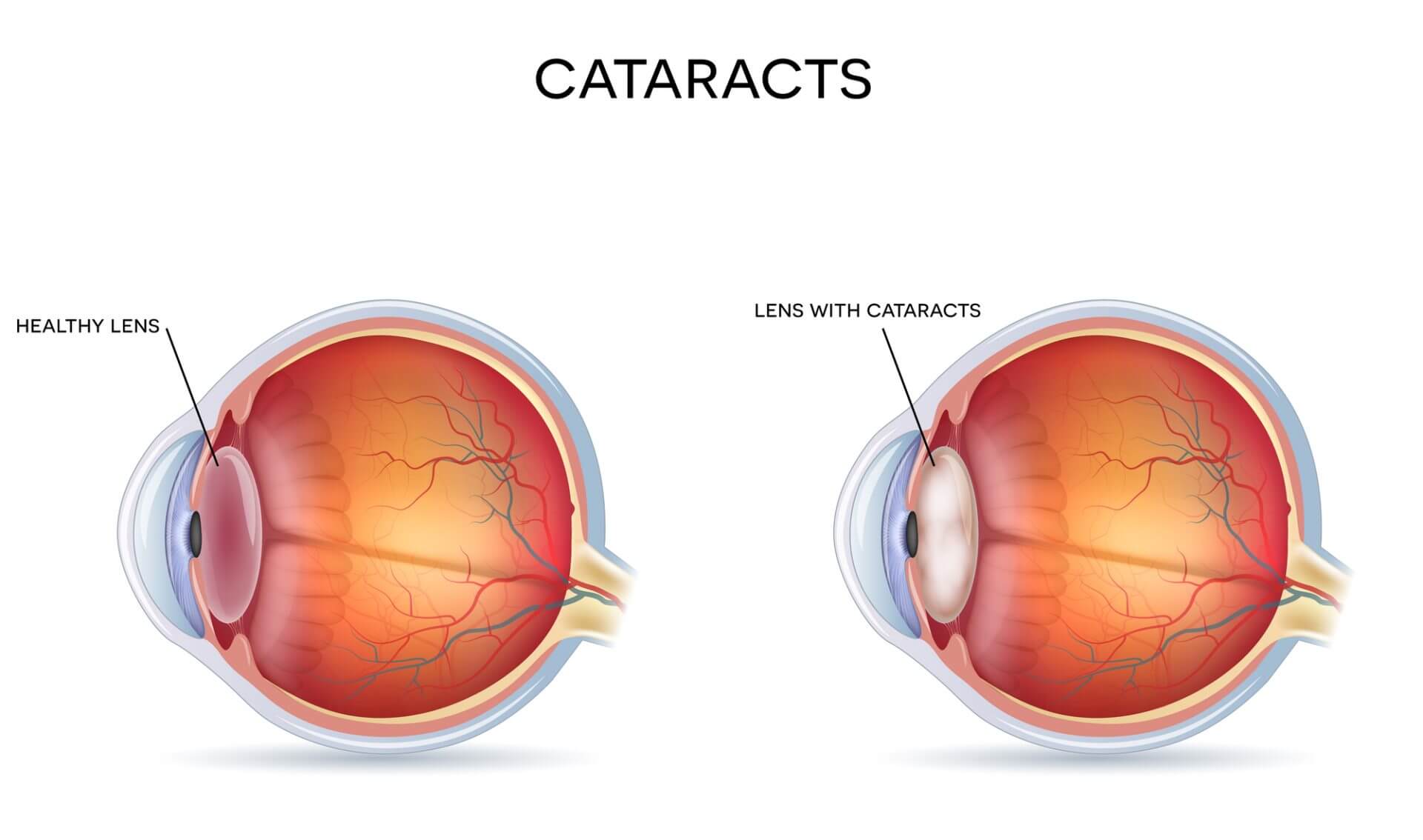 Difference between eyes with and without cataracts