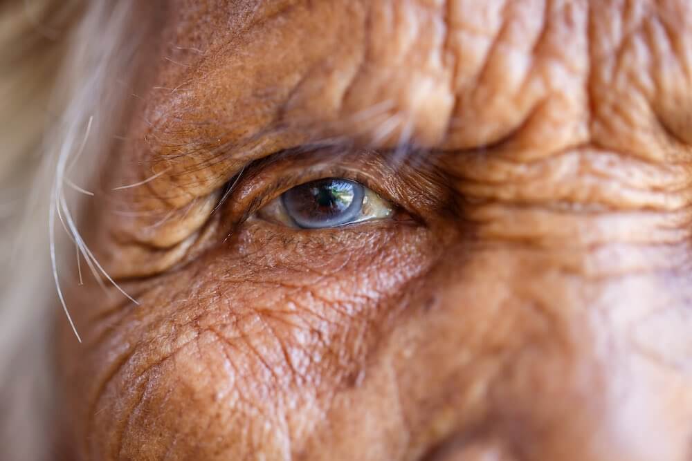 Elderly person with eye cataracts