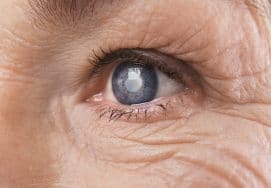 Close up of an elderly persons eye with a cataract