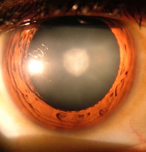 Eye with a cataract