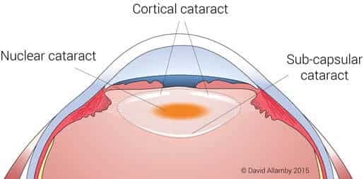 Eye Diagram showing Nuclear cataract, cortical cataract and sub-capsular cataract