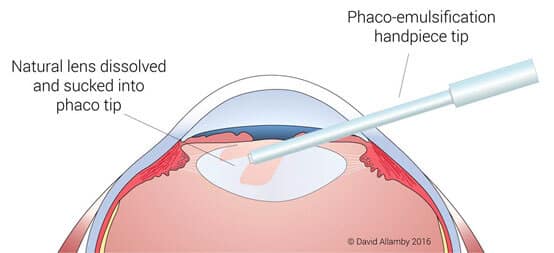 Cataract Surgery Step 1