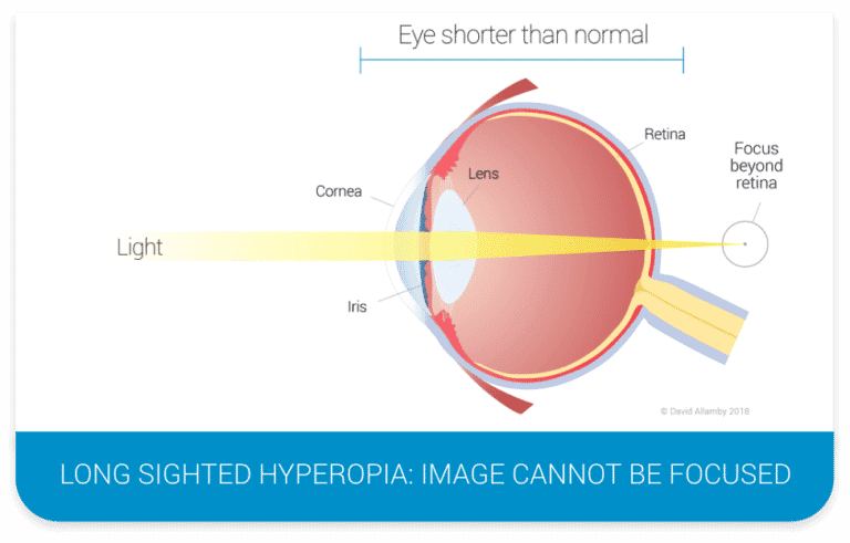 Hyperopia