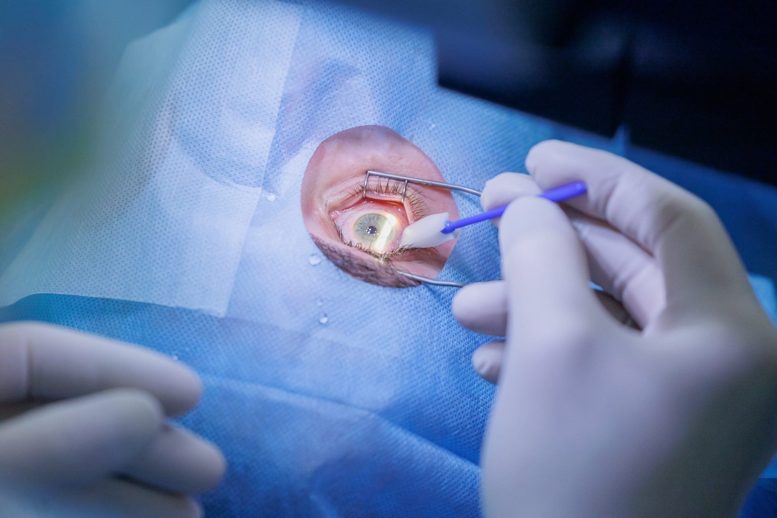 What Happens During Laser Eye Surgery?