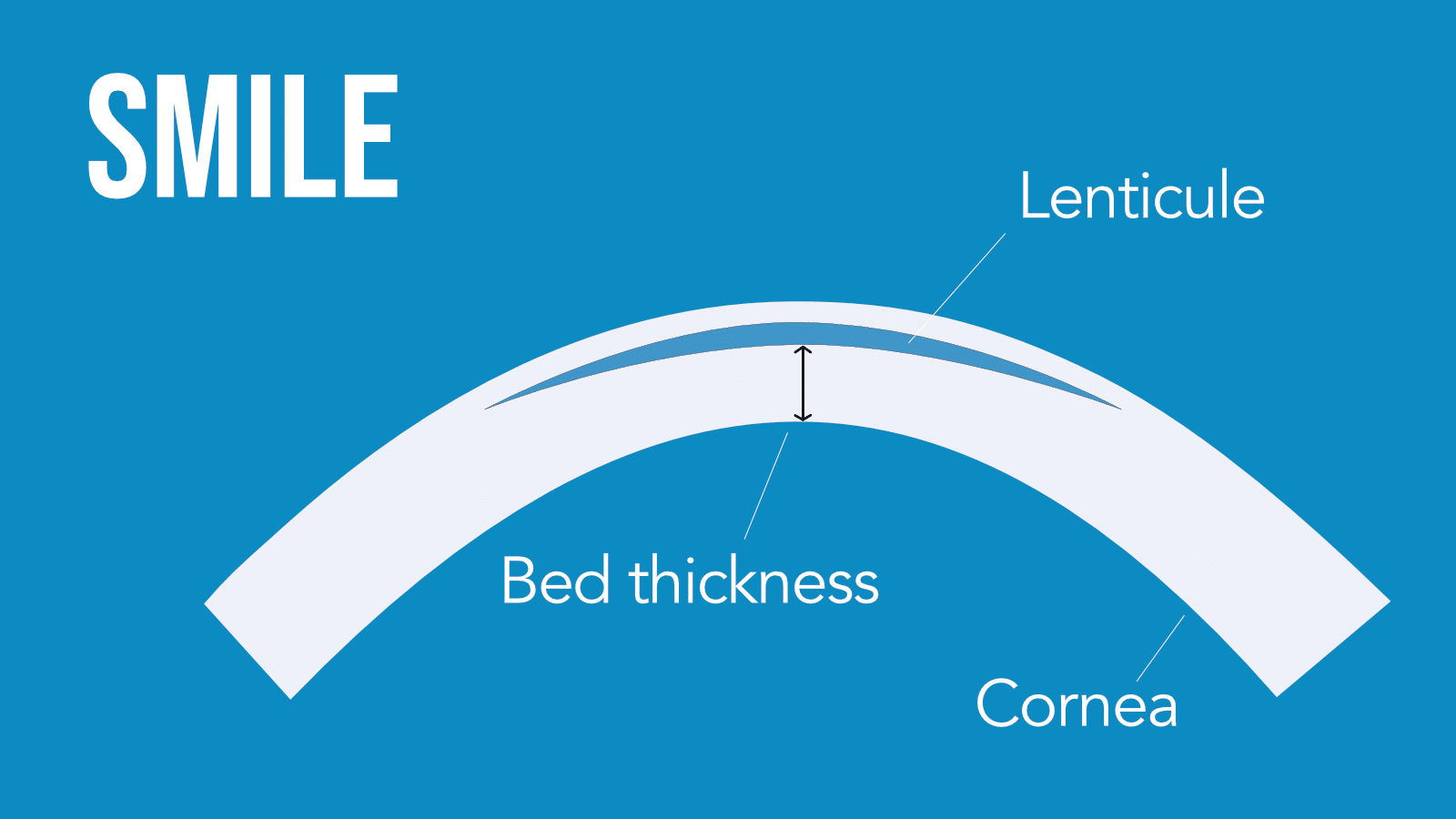 SMILE residual bed thickness