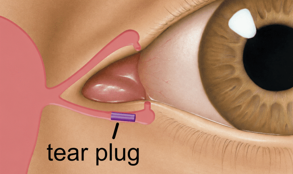 tear plug before LASIK